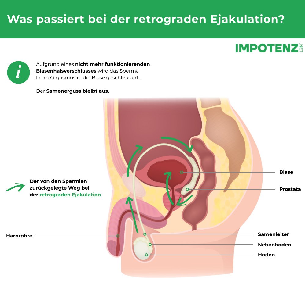 Ejakulation prostata Impotenz durch